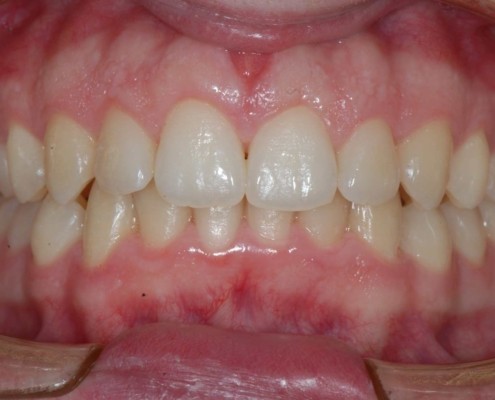 Invisalign dopo invisalign