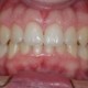 invisalign